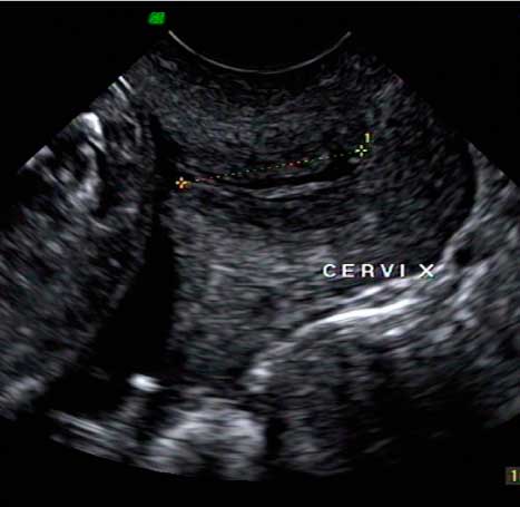 cervicometria-instituto-peruano-de-medicina-y-cirugia-fetal
