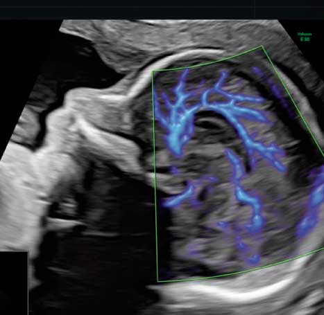 neurosonografia
