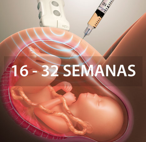 amniocentesis-instituto-peruano-de-medicina-y-cirugia-fetal