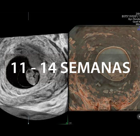 biopsia-de-vellosidades-coriales-instituto-peruano-de-medicina-y-cirugia-fetal