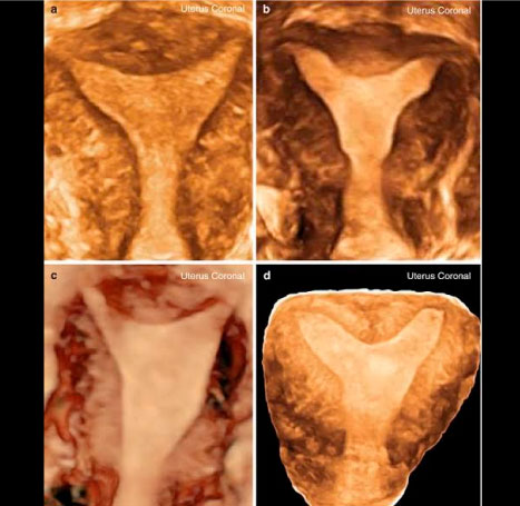ecografia-ginecologica-doppler-transvaginal2