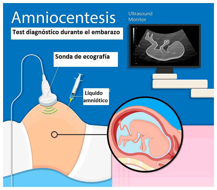 amniocentesis